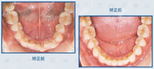 上海维乐口腔拥挤下颌牙列矫正对比