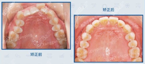 上海维乐口腔拥挤上颌牙列矫正对比 上海维乐口腔拥挤上颌牙列矫正对比
