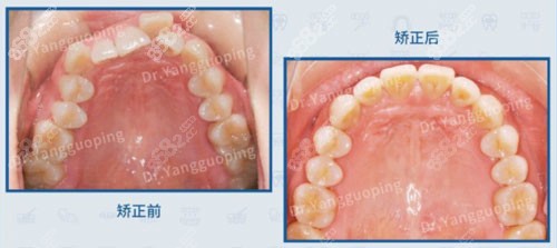 上海维乐口腔拥挤上颌牙列矫正对比