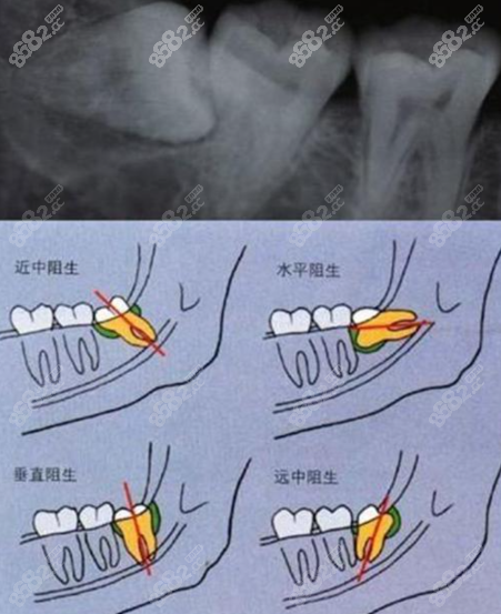 什么情况下需要拔智齿,需要注意什么,不拔会有什么危害吗?