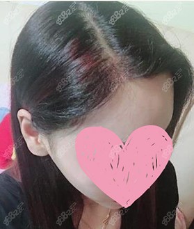 合肥丛生植发术后 合肥丛生植发术后