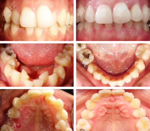上海尤旦口腔医院牙列重度拥挤矫正<span style=
