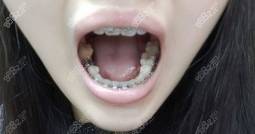 上海永华口腔金属自锁矫正+种植牙术后照片 上海永华口腔金属自锁矫正+种植牙术后照片