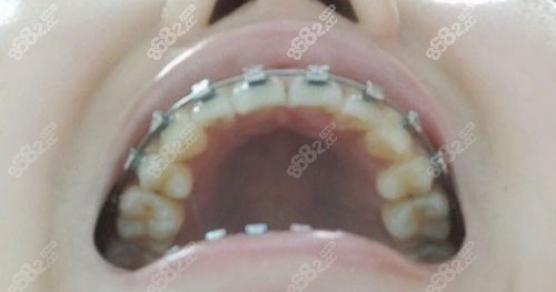 上海永华口腔金属自锁矫正术后照片 上海永华口腔金属自锁矫正术后照片