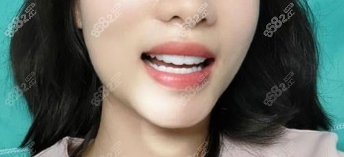 上海永华口腔牙齿美白贴面术后照片 上海永华口腔牙齿美白贴面术后照片