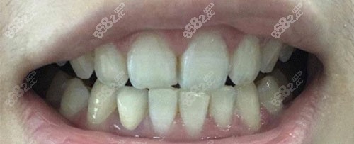上海永华口腔牙齿美白贴面术前照片 上海永华口腔牙齿美白贴面术前照片