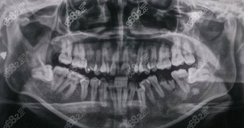 上海永华口腔牙齿矫正术前CT拍片 上海永华口腔牙齿矫正术前CT拍片