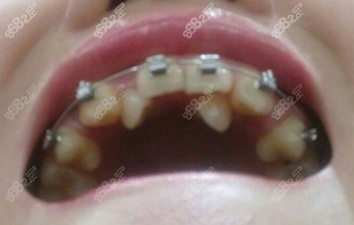 上海永华口腔金属自锁矫正术前照片 上海永华口腔金属自锁矫正术前照片