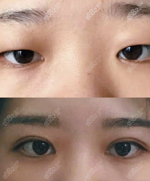 从我肿眼泡全切双眼皮恢复图看杭州陆新医生割双眼皮咋样