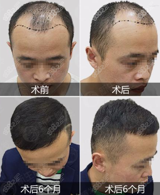 植发庐江(头顶植发大概要多少钱)