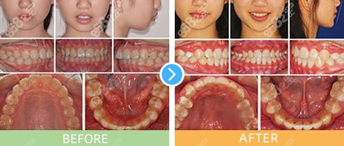 上海正睿齿科嘉一口腔隐适美隐形矫正<span style=