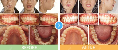上海正睿齿科嘉一口腔金属自锁托槽矫正案例 上海正睿齿科嘉一口腔金属自锁托槽矫正案例