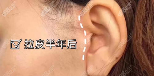 从中下面部耳前拉皮刀口恢复图片来看,术后到底会不会留疤