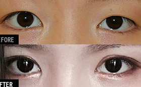 韩国爱护整形医院眼部整形前后对比照