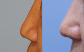 韩国爱护整形医院鼻部整形前后对比照