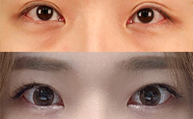韩国TS整形外科的眼修复怎么样?李相均双眼皮整形特点如下