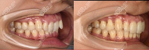 虎牙矫正前后对比