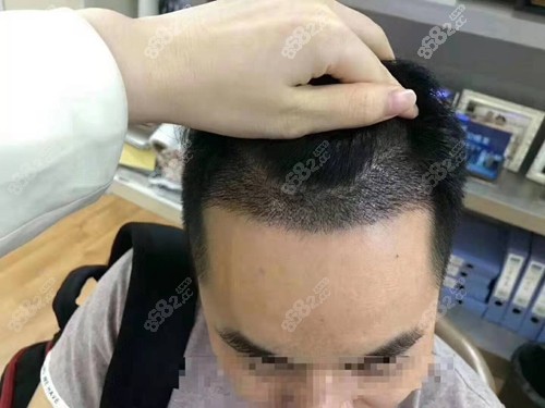 m型发际线植发大概多少钱?种植1000单位有多大面积?