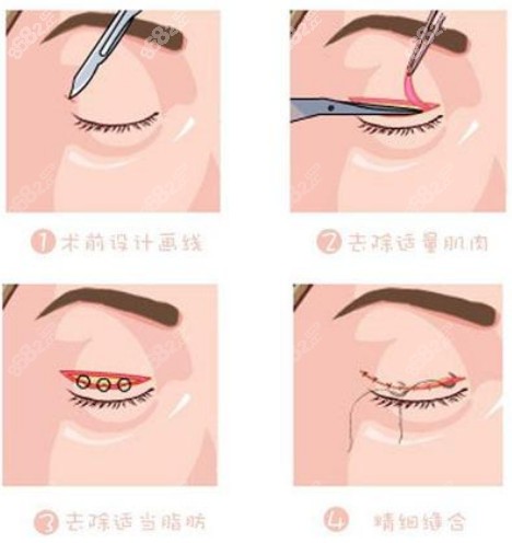北京冯显雅医生修复全切双眼皮的价格挺合理具体得花多钱