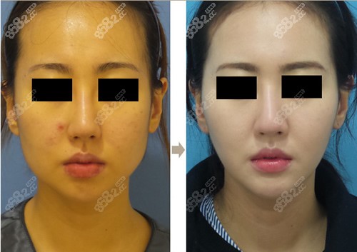 吸脂前后对比图