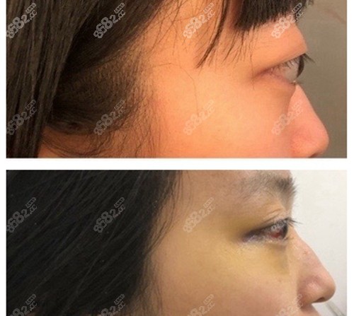 首页 对比照片 眼部对比照 正文眼睛近视后导致的眼球突出问题是不