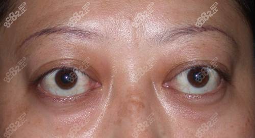 眼球因为近视突出了怎么办?哪里做突眼矫正效果比较好?