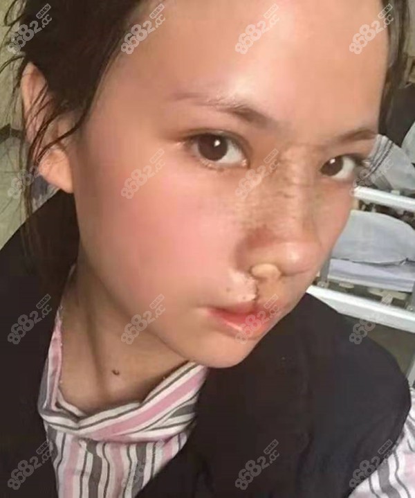 分享下重庆美仑美奂毋巨龙医生做唇裂鼻畸形修复真人实例