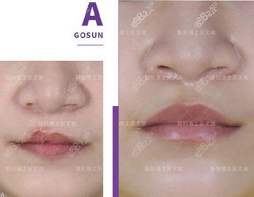 广州唇腭裂哪个医院做的好坐诊医生及前后对比图一览