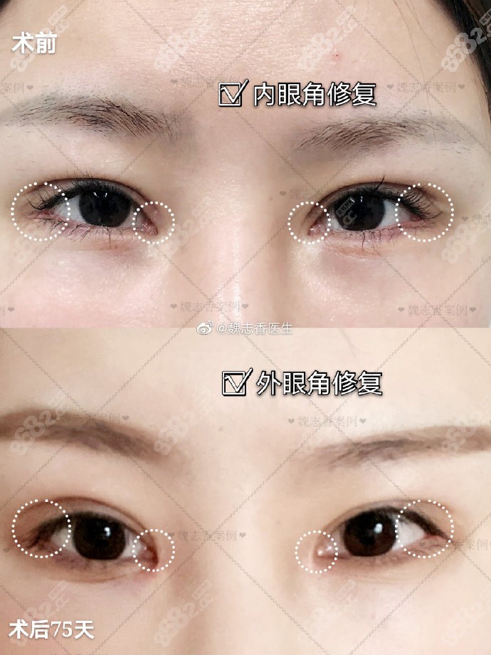 附眼角回包修复效果