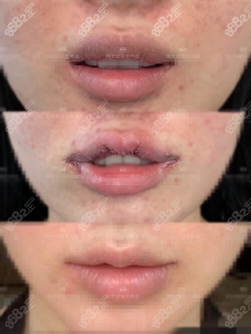 厚唇变薄手术效果图图片