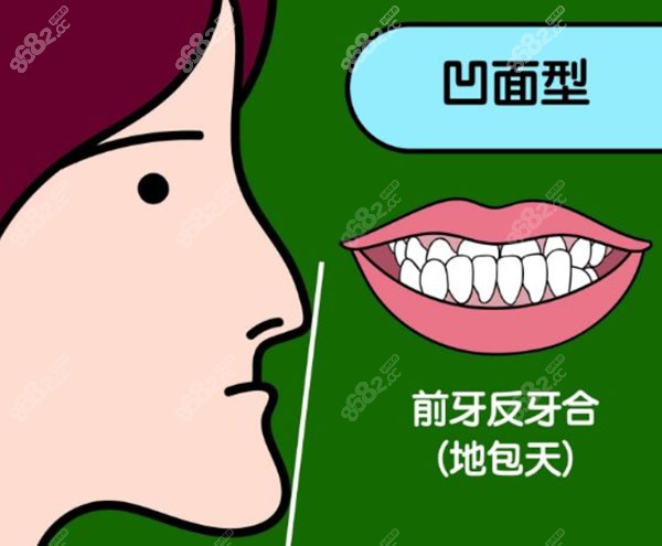上海九院骨性地包天和龅牙矫正手术费用公布,正颌 正畸价格