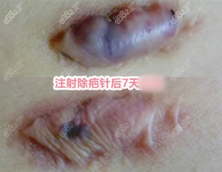 顺德壹加壹整形美容口腔医院疤痕软化针对比图