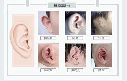 耳朵分几种类型图片图片