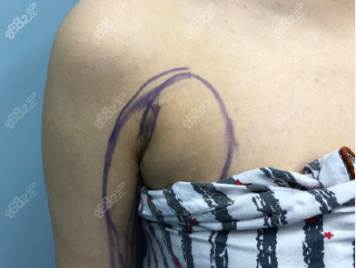 腋下副乳图片图手术图片