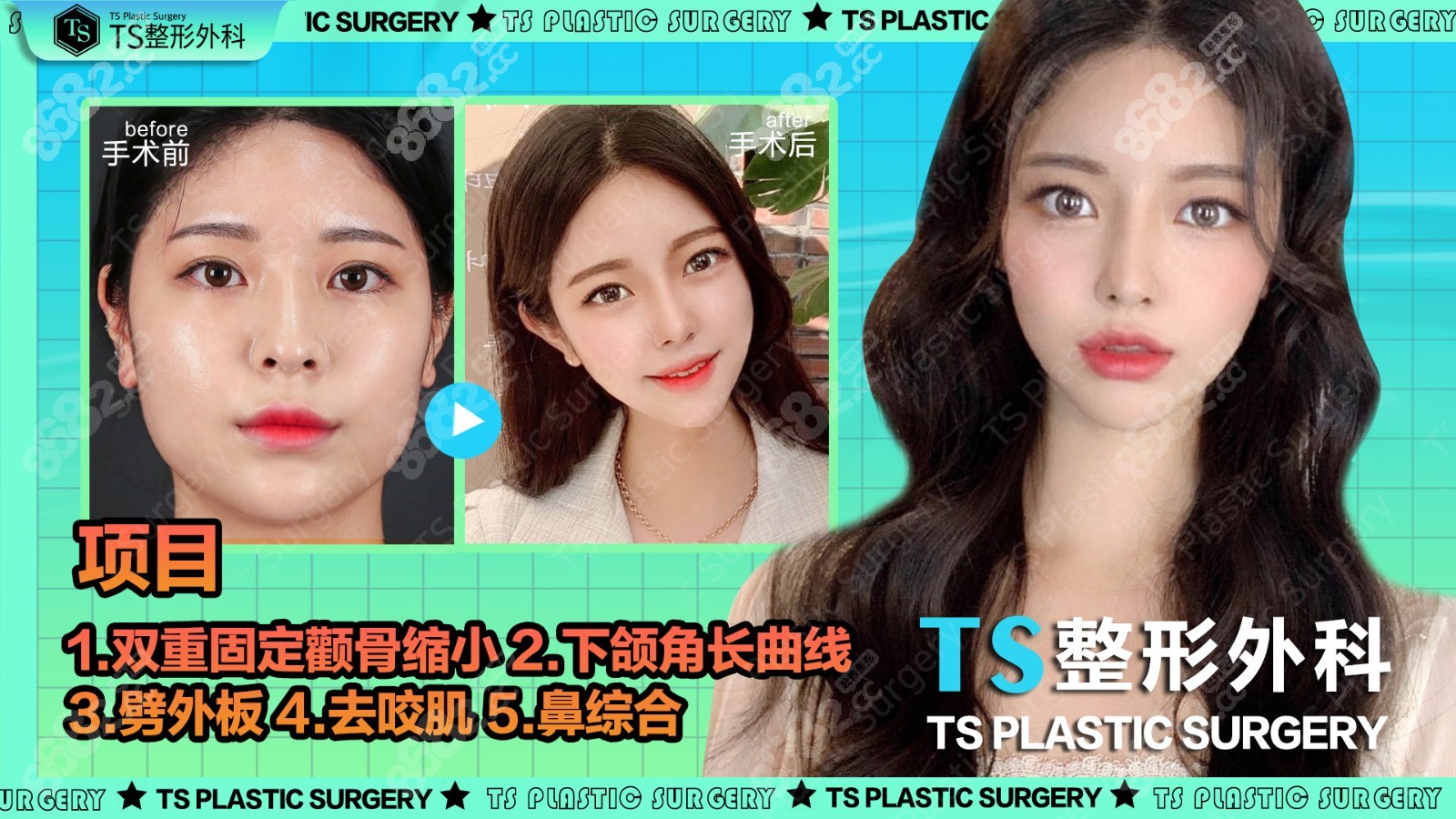 韩国ts整形隆鼻和轮廓手术一年后真人恢复记录 看效果如何 颧骨整形 86赴韩整形网 韩国ts整形隆鼻和轮廓手术一年后真人恢复记录 看效果如何 颧骨整形 86赴韩整形网