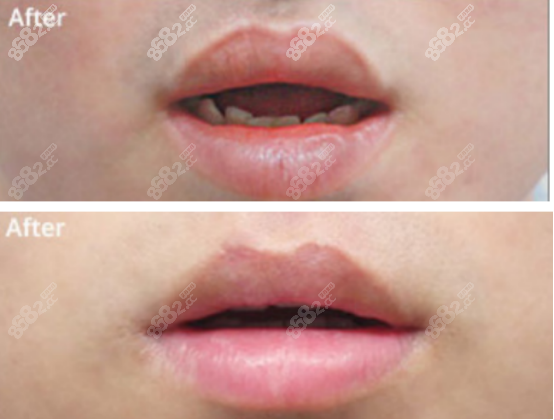 看北京八大处宋涛唇隐裂实例,了解口碑和修复技术怎么样