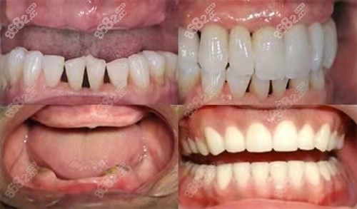 70岁老人适合种牙还是装假牙,全口镶牙,种植牙价格是多少