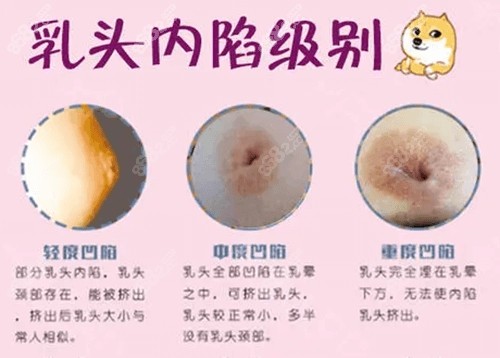 乳头凹陷什么样子图片