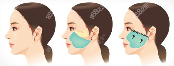 筋膜悬吊面部提升能维持多久