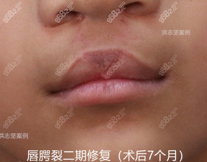 南京唇裂手术哪个医生好看洪志坚医生做的唇裂修复后照片