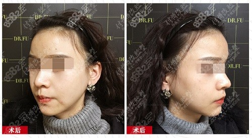 面部不对称手术前需要做哪些准备？
