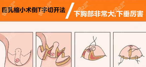 首页 韩国整形 胸部塑形 巨乳缩小 正文适用人群:乳房肥大,不下垂