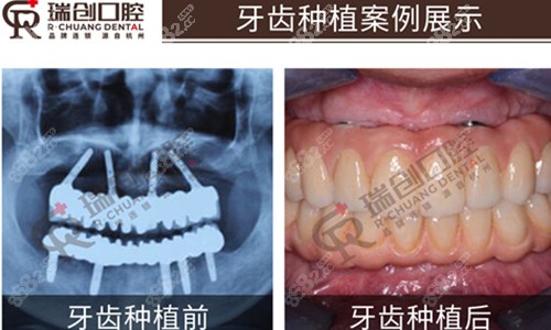 分享2022杭州瑞创口腔价格表及种植牙 牙齿矫正坐诊医生