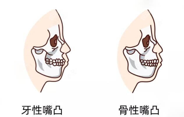 骨性凸嘴会越来越凸吗