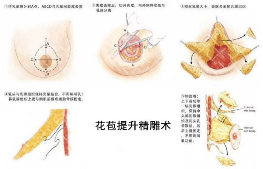 双环提升乳房手术步骤图片