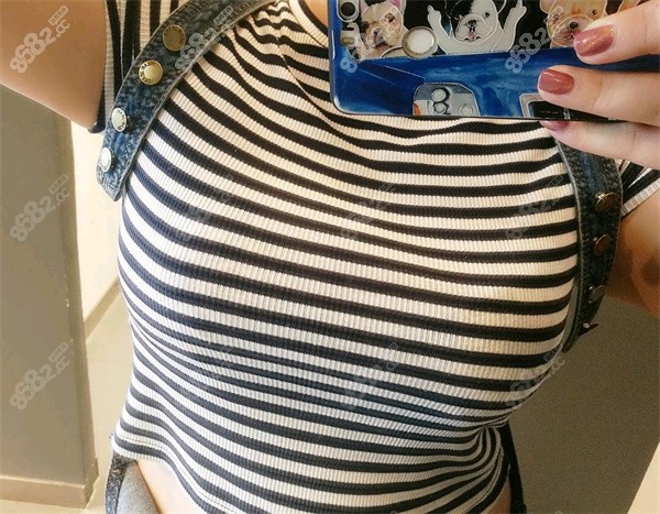 是b罩杯,经历一个月就恢复好了,自述脂肪流失挺少的,胸部现在是c罩杯