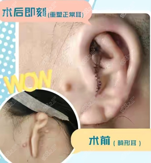 副耳手术多少钱？