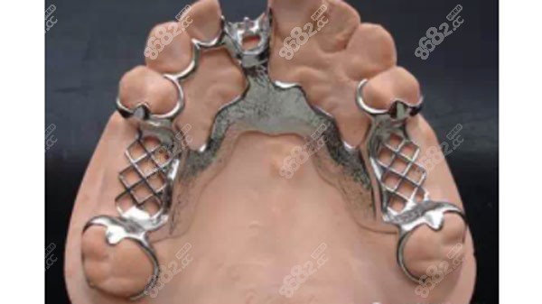 纯钛全口活动义齿假牙