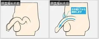 延长术图片过程图片