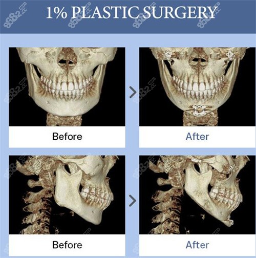 韩国1%整形下颌角手术CT